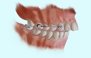 Dispositif de Carrière - Traitement des malocclusions