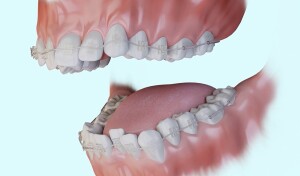 Traitement orthodontique - Appareil multi-attache en céramique